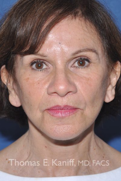 Front image of patient after receiving deep plane facial treatment improving jawline and midface lift