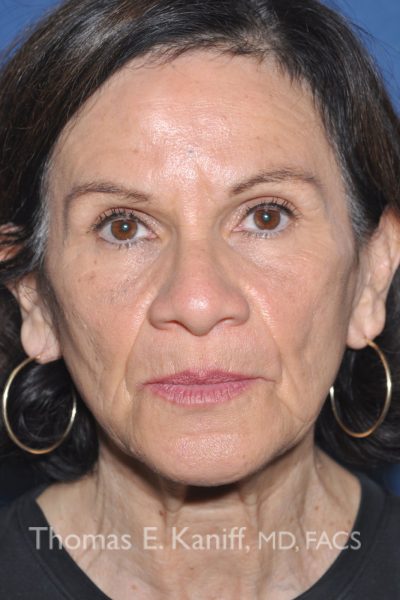 Front image of patient prior to receiving deep plane facial treatment