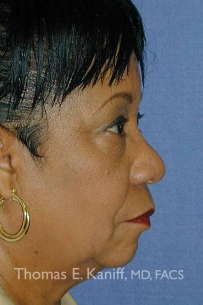 Pre-operative photo of face with recessed chin and underdeveloped cheekbones