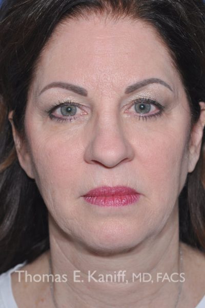 Front profile of patient before deep plane factlift