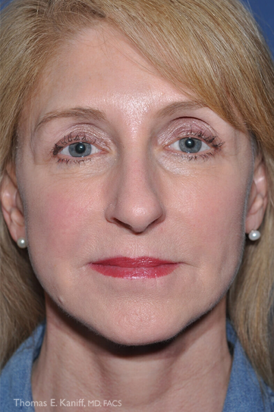 After fat transfer with reduced under-eye hollows and balanced features