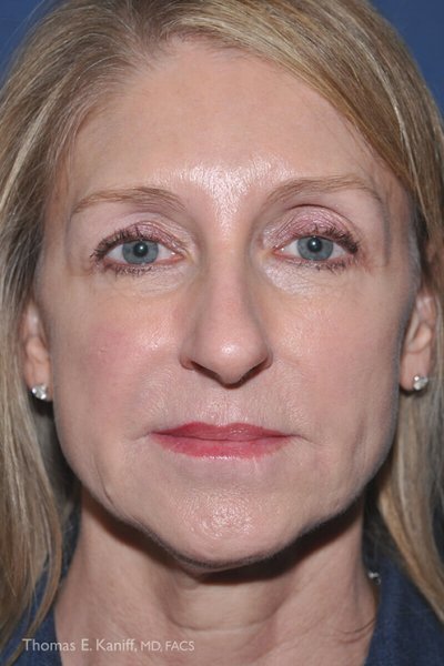 Patient front profile showing pre-treatment under-eye hollows and age-related volume loss