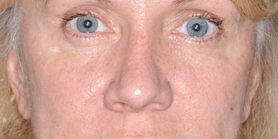 Patient 1147_Brow Lift_After_Front_525x756-WM