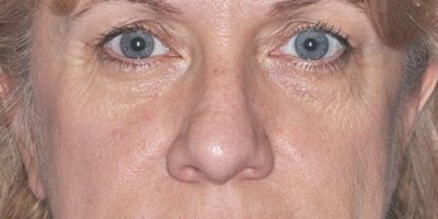 Patient 1147_Brow Lift_Before_Front_525x756-WM