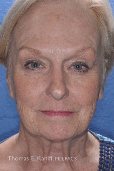 Before facial rejuvenation with fat transfer showing contour irregularities