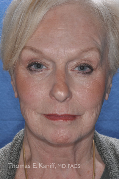 After cosmetic fat grafting showing natural-looking facial enhancement