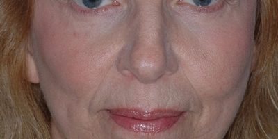Patient 1156_Brow Lift_After_Front_525x751-WM