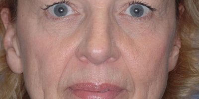 Patient 1156_Brow Lift_Before_Front_525x751-WM