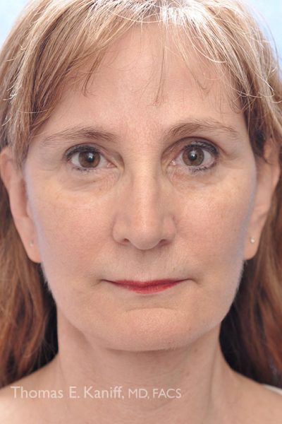 Patient front profile showing results after fat injections with enhanced midface definition