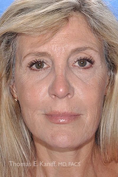 Post-fat transfer results with rejuvenated temples and midface