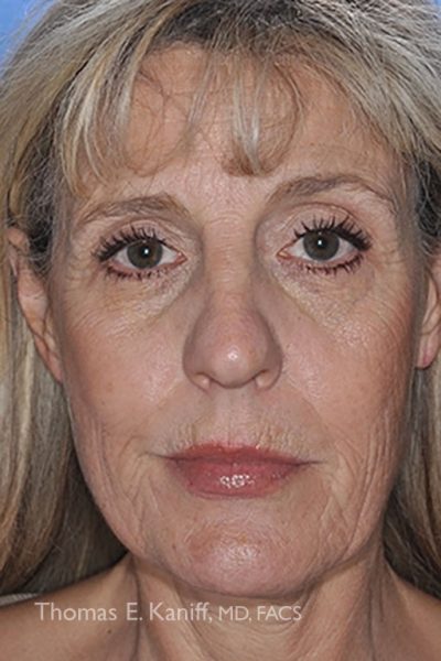 Pre-operative facial photo revealing volume depletion and fine lines