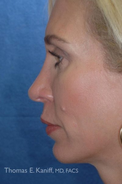 Patient 1255_After_Side - 556x768 - WM
