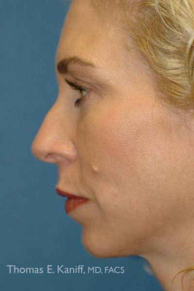 Patient 1255_Before_After - 556x768 - WM