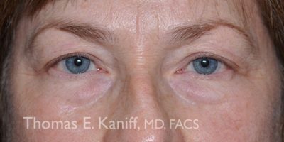 Before eyelid surgery showing sagging upper eyelids and excess skin