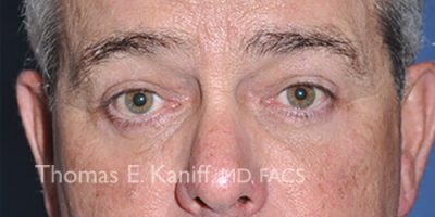 Front profile of patient after eyelid surgery showing smoother, tightened upper eyelids