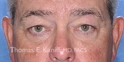 Front view before eyelid and brow lift showing drooping lids and tired appearance