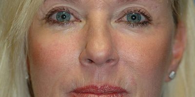 Front profile of patient post–mini facelift image showing refreshed lower face contour