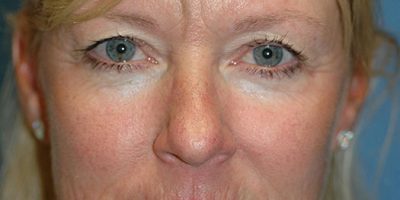 Front profile of patient before mini facelift photo showing mild neck skin looseness