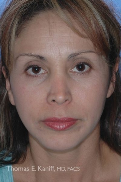 Patient 1425_Mini-Faclift_After_Front - 538x768 -WM