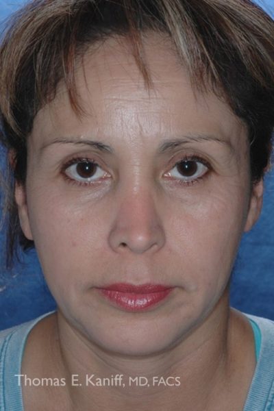 Patient 1425_Mini-Faclift_Before_Front - 538x768 - WM