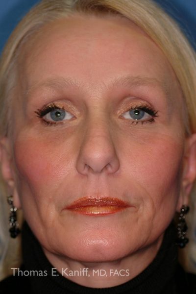 Patient 1435_Mini-Faclift_After_Front - 537x768 - WM