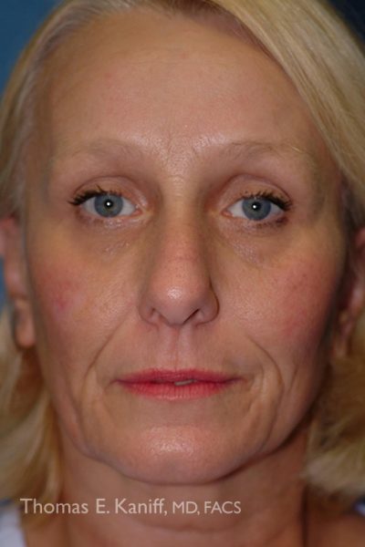 Patient 1435_Mini-Faclift_Before_Front - 537x768 - WM