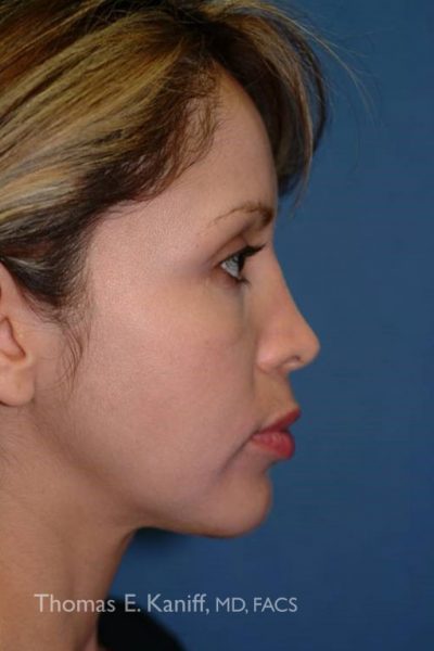 Side profile of patient after chin implant with improved chin projection and contour