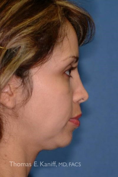 Patient side profile before chin implant showing weak chin projection