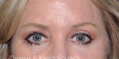After brow lift image showing elevated brow position and brighter eyes