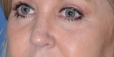 Patient 1606_Brow Lift_After_Side_525x758-WM