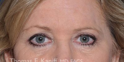 Patient before brow lift image showing low eyebrow position and forehead heavines
