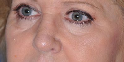 Patient 1606_Brow Lift_Before_Side_525x758-WM