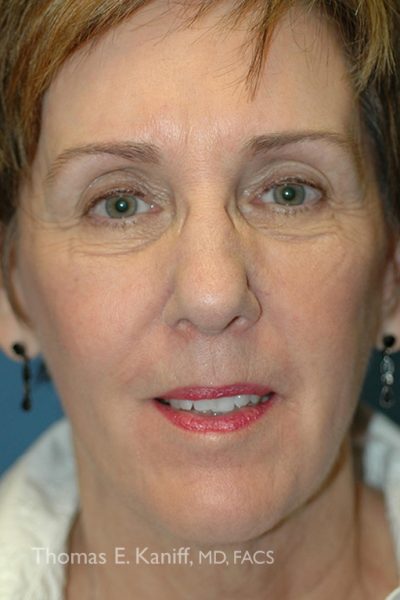 Patient results after neck lift surgery showing tightened skin and defined jawline