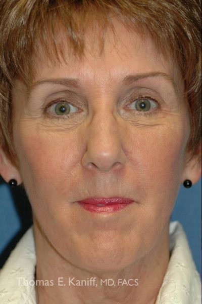 Patient neck appearance before neck lift surgery showing sagging skin and visible banding