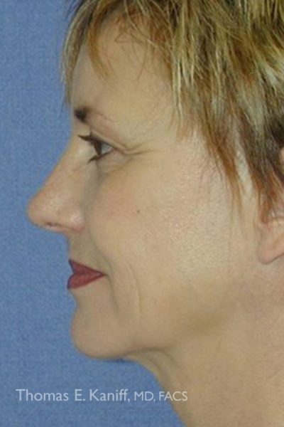 Post-neck lift image with improved neck contour and reduced sagging
