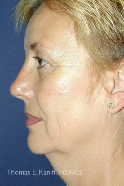 Pre-procedure photo displaying excess neck skin and loss of jawline definition