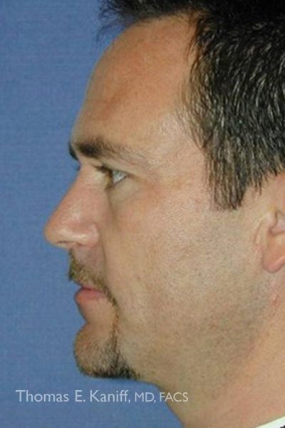 Patient side profile post-procedure neck rejuvenation showing lifted tissue and youthful contour.