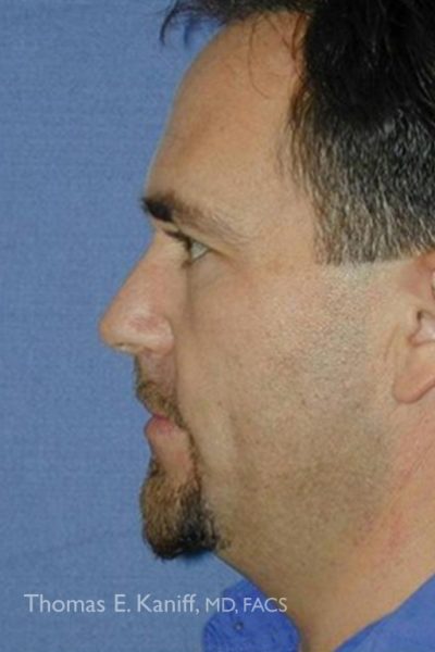Patient side profile showing neck before cosmetic neck lift with loose skin under the chin