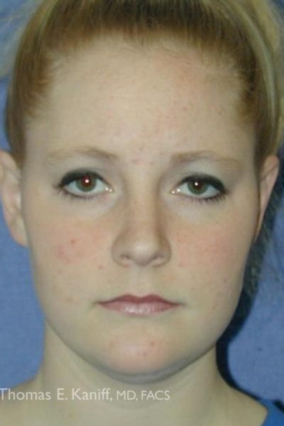 Patient 1715_Neck Lift_Before_Front - 601x768 - WM