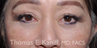 Post–lower eyelid surgery photo with reduced under-eye puffiness