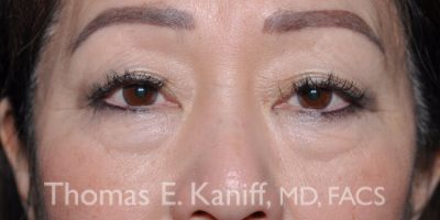 Pre-procedure photo showing under-eye bags before lower eyelid surgery